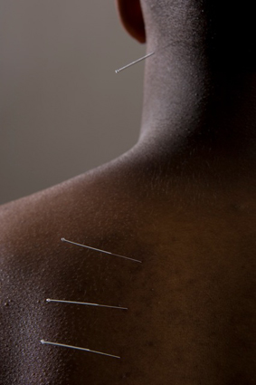 Acupuncture on the neck